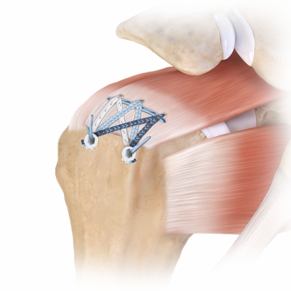 Rotator cuff tear treatment and shoulder surgery